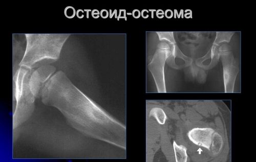 Диагностика и лечение на остеоид-остеоми на костите