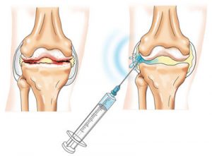Ефективни болкоуспокояващи за остеоартрит на коляното, тазобедрената става, раменните стави