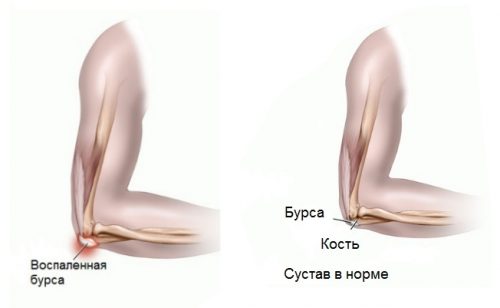Ефективно лечение на бурсит в ставите: лакът, коляно, рамо