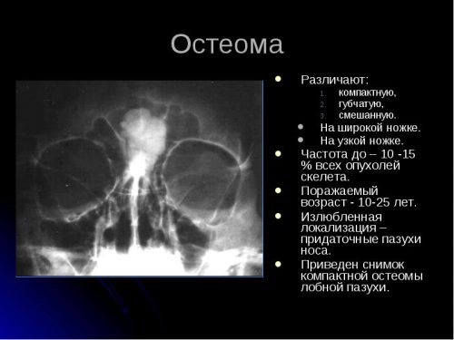 Характеристики на развитието на остеома на челната кост и нейното проявление