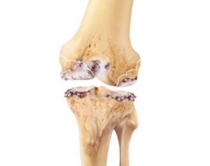 Характеристики на артропластиката на коляното