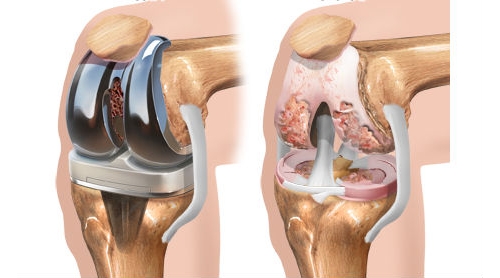 Характеристики на артропластиката на коляното