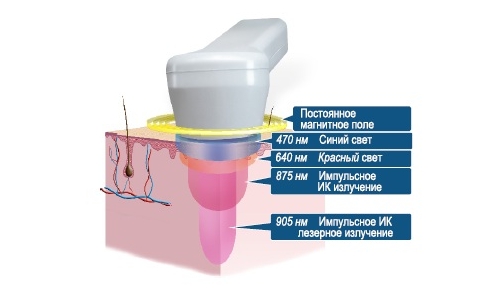 Характеристики на лазерното отстраняване на калценалната сърцевина