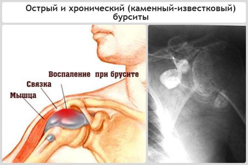 Характеристики на проявата и лечението на бурсит на рамото