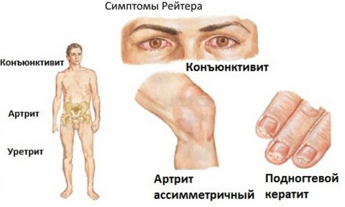 Характеристики на проявата и лечението на синдрома на Reiter