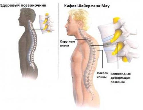Характеристики на проява на остеохондропатия и нейното лечение