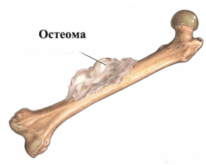 Характеристики на остеома на бедрената кост