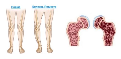 Характеристики на проявата на болестта на Paget и костната система