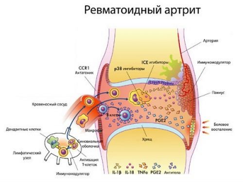 Характеристики на храненето при ставите на ревматоидния артрит