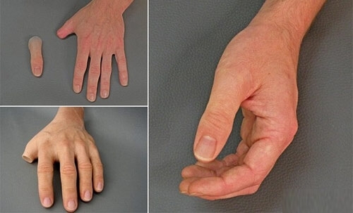 Характеристики на протезата на пръстите и пръстите на краката