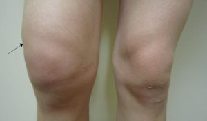 Характеристики на лечението на острата артроза на колянната става