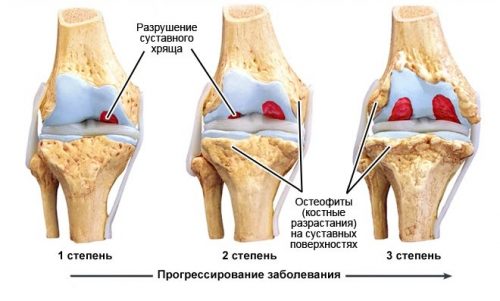 Характеристики на лечението на острата артроза на колянната става