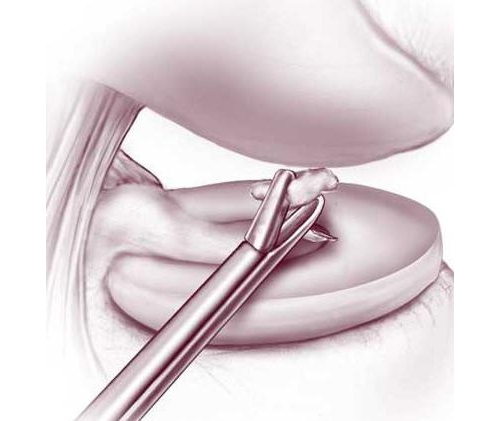 Характеристики на лечението на ставните мишки на колянната става