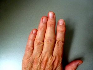 Характеристики на лечението на карпалния артрит