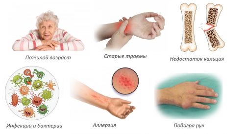Характеристики на лечението на карпалния артрит