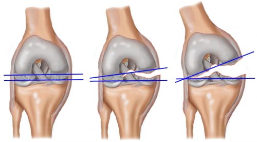 Характеристики на лечение на хемартроза на колянната става