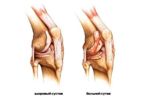 Характеристики на лечение на колянни артрити в различни форми