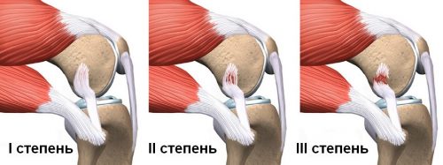 Характеристики на лечението на синдрома "коляно подвижен"