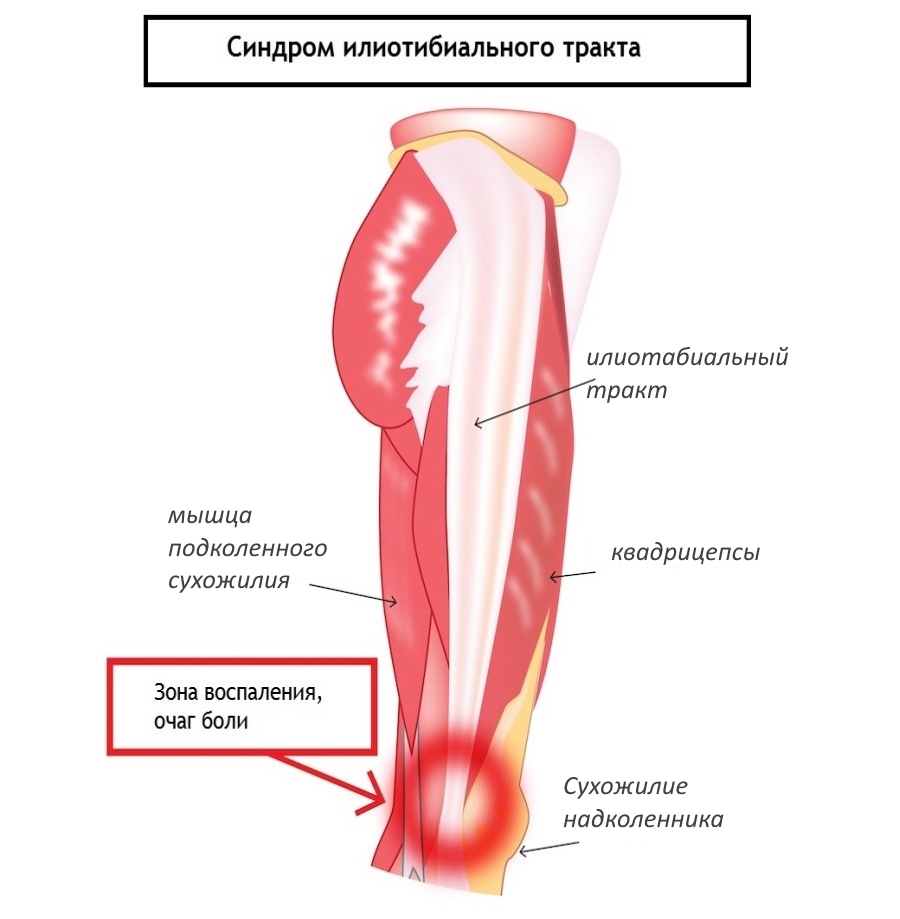 Характеристики на лечението на синдрома "коляно подвижен"