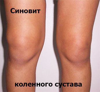 Народни средства за лечение на синовит на колянната става в дома