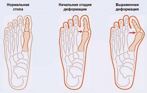 Hallux valgus: степени и лечение на големия пръст