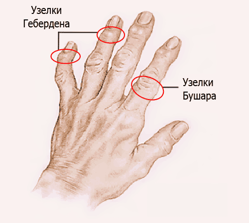 Как се лекува остеоартрит на пръстите и китките?