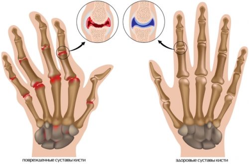 Как се лекува остеоартрит на пръстите и китките?
