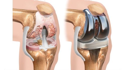 Как да получите квота за протезно коляно съединение?