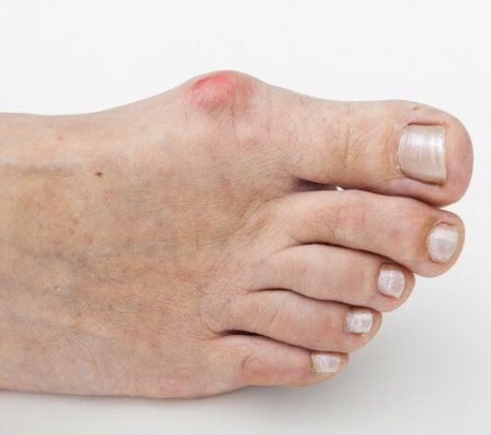 Как да спрем растежа на костите на крака близо до палеца?