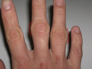 Как да се третира костите на пръстите с народни средства?