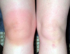 Как да се лекува възпаление в колянната става?