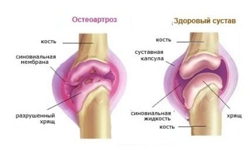 Как да се лекува остеоартроза на крака?