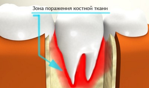 Проявление на остеомиелит на челюстта и методи за неговото лечение