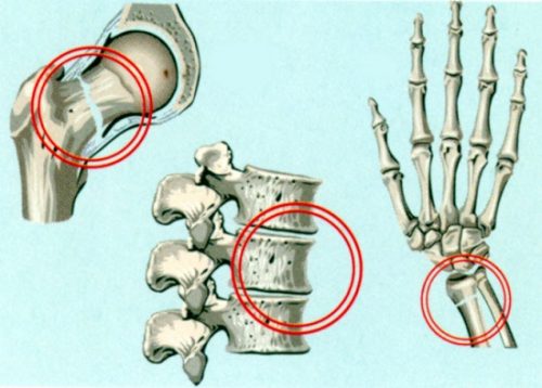 Масаж за остеопороза на гръбначния стълб, бедрото и коляното