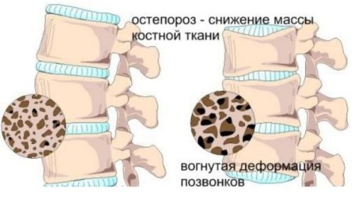 Масаж за остеопороза на гръбначния стълб, бедрото и коляното