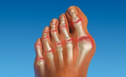 Методите за лечение на артрит на големия пръст