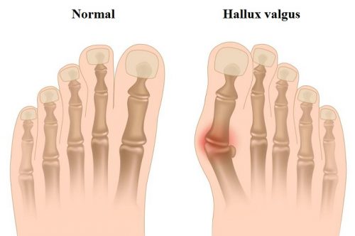 Методи за хирургично лечение на Hallux Valgus
