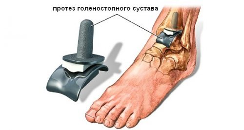 Методи за лечение на остеоартрит на глезена в различни степени