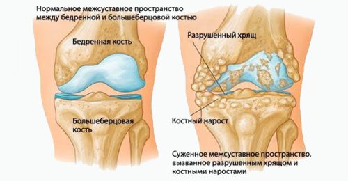 Методи за лечение на остеохондроза на колянната става