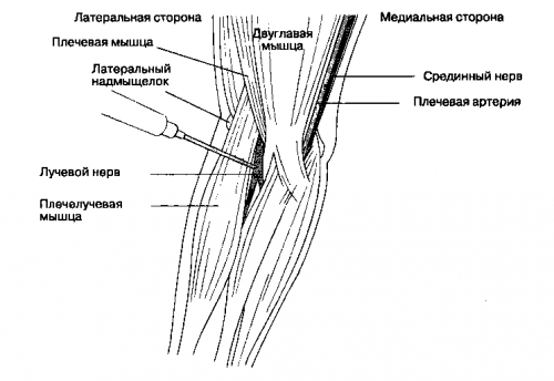Методи за лечение на страничния епикондилит на лактите