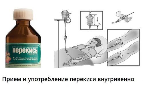Neumyvakin: лечение на ставна артроза с водороден прекис