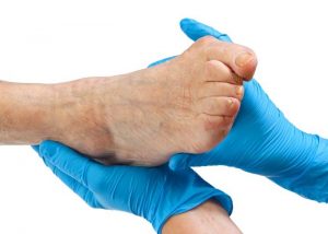 Нехирургично лечение на деформация на валгус на големия пръст