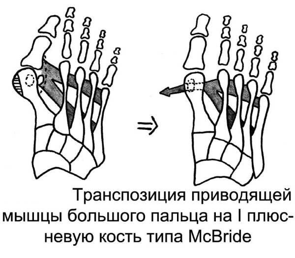 Операция за премахване на камъка на големия пръст