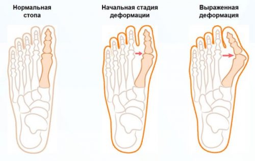 Ортопедични чорапи Valgosoks от кост на краката или краката