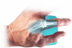 Артроза на ставите на пръстите: етапи и видове, симптоми, лечение