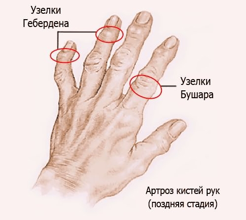 Артроза на ставите на пръстите: етапи и видове, симптоми, лечение