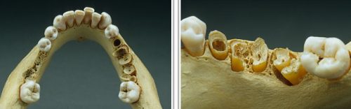Остеопороза на гърба на турското седло и челюстта: симптоми и лечение