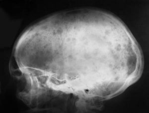 Остеопороза на гърба на турското седло и челюстта: симптоми и лечение