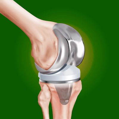 Характеристики на синокектомията на колянната става