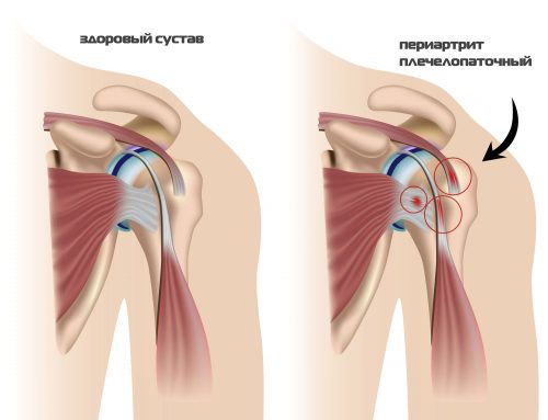 Техниката на Попов за лечение на хомеопарен периартрит